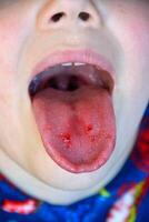 fechar-se do lábios, língua, protrusão do sangue. criança mordido língua. foto
