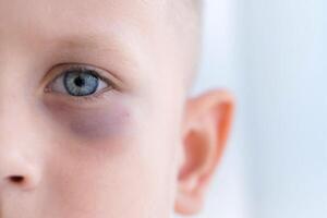 fechar-se do uma criança olho com uma hematoma. uma Rapazes face com uma Preto olho. foto