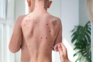 tratamento do úlceras a partir de catapora, varicela com médico creme em a criança pele. mãe guloseimas a criança costas com vermelho remédio. foto