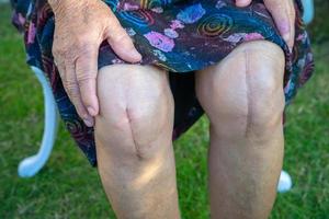 paciente idosa asiática sênior mostra suas cicatrizes Substituição cirúrgica total da articulação do joelho. foto