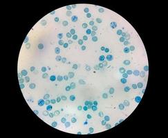 visão microscópica próxima da contagem anormal de reticulócitos no departamento de hematologia, coloração com azul de metileno foto