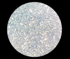 visão microscópica próxima da contagem anormal de reticulócitos no departamento de hematologia, coloração com azul de metileno foto