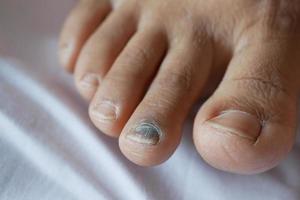 close-up dos dedos dos pés infectados das mulheres na cama, foto