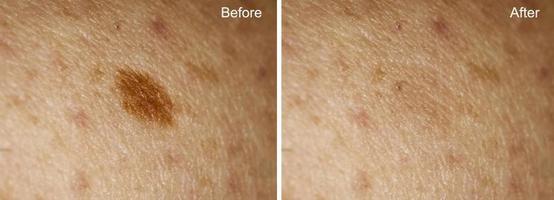 foto antes e depois da remoção de grande verruga na pele da mulher. foco seletivo. conceito de remoção de toupeira