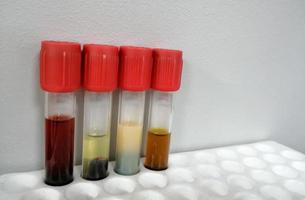 tipos comuns de erros de amostras de soro sanguíneo. diferentes tipos de amostra que interferem no resultado do teste. foto