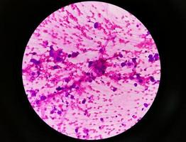 fotomicrografia de adenocarcinoma metastático de pulmão foto