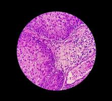 fotomicrografia de um papiloma invertido nasossinusal um tumor benigno que pode ocorrer na cavidade nasal ou seios paranasais, 40x foto