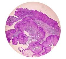 fotomicrografia de um papiloma invertido nasossinusal um tumor benigno que pode ocorrer na cavidade nasal ou seios paranasais, 10x foto