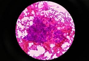 fotomicrografia de carcinoma mucoepidermóide de glândula parótida foto