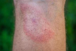 eritema migratório após uma picada de carrapato na perna de um homem foto