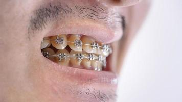 close-up da boca do homem com aparelho, dentes de placa amarela porque bebe café regularmente