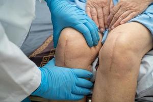 paciente idosa asiática ou idosa mostra suas cicatrizes artroplastia cirúrgica de sutura de sutura de substituição total da articulação do joelho na cama no hospital de enfermagem. foto