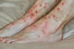 pés masculinos com muitas manchas vermelhas e cicatriz de picada de inseto. irritação severa na pele. foto
