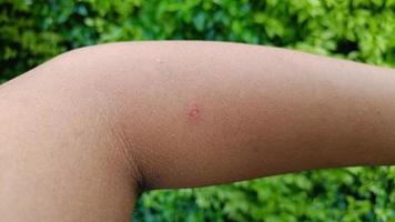 pequena ferida sangra no braço de um homem. foto