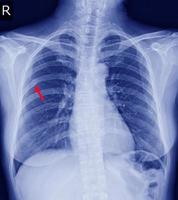 radiografia de tórax fratura posterior direita 6ª costela e possível fratura aspecto lateral da 9ª costela esquerda. foto