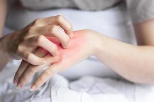 mão de mulher de close-up coçando erupção vermelha nas costas da mão devido a alergia ao corpo ou picada de inseto foto