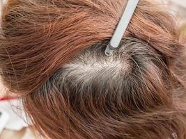 cabeça de mulher com queda de cabelo, queda de cabelo foto