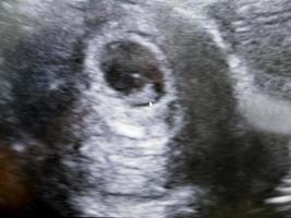 ultra-som obstétrico de embrião na sexta semana foto