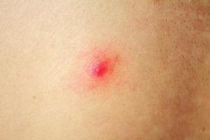 acne com manchas vermelhas nas costas foto
