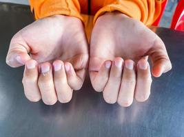 close-up de dedos de pele rachada descamação seca, unhas da mão da jovem fêmea. descamação da pele devido a uma reação alérgica. foto