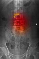 radiografia computadorizada cr da espinha lombosarcal anteroposteriorap mostrando espinha de espondilose e escoliose. foto