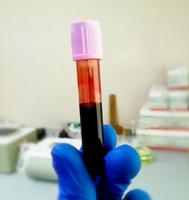 técnico segura tubo de lavanda com amostra de sangue para exame hematológico ou de sangue total. foto