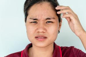 close-up da jovem asiática se preocupa com o rosto quando ela tem problemas com a pele do rosto. problemas com acne e cicatriz na pele feminina. problema skincare e conceito de saúde. foto