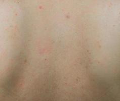 closeup de acne nas costas com mancha vermelha e mancha marrom escura na pele das costas da mulher. foto