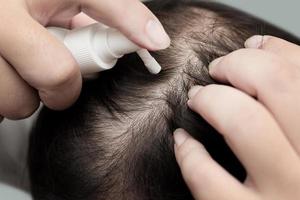 close-up da mão masculina usando medicação no couro cabeludo, tratando alopecia, perda de cabelo, caspa ou problema de cabelo foto