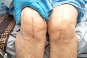 médico asiático injeta plasma rico em plaquetas de ácido hialurônico no joelho de uma mulher idosa para andar sem dor. foto