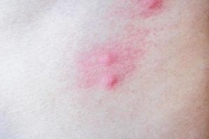 alergia de pele de picadas de mosquito foto