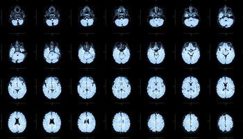 ressonância magnética do crânio e cérebro de uma pessoa com malformações cerebrais, diagnóstico preliminar, holoproencefalia, ausência, agenesia do septo transparente, menino de um ano, vista superior. foto