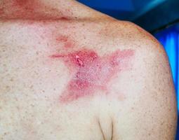 inflamação da pele com úlcera causada por uma picada de inseto, feridas de picadas de insetos tem queimaduras vermelhas do vírus.foco suave. foto