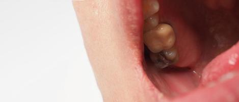 tratamento de canal de dente cariado. dente ou cárie dentária do molar inferior. foto