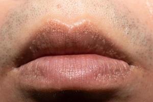 close-up de manchas de fordyce nos lábios. foto