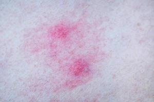 alergia de pele de picadas de mosquito foto