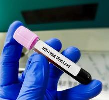 amostra de sangue para teste de carga viral hiv 1 rna. foto