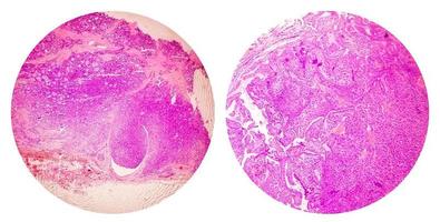 colagem de fotos de imagem microscópica mostrando carcinoma papilífero de tireoide.