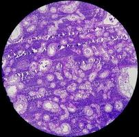 fotomicrografia ou imagem microscópica de câncer de estômago. adenocarcinoma do estômago foto