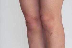 pernas com marca de nascença oval permanente foto