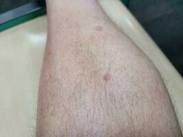 inchaço vermelho levantado ou varíola na perna masculina com cabelo foto