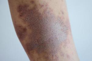 doença de pele menina erupção vermelha causada por alergias a drogas, alimentos, produtos químicos, sistema imunológico deficiente na linfa. foto