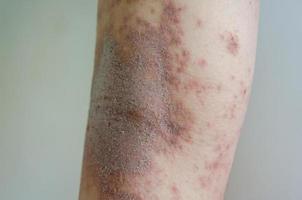 doença de pele menina erupção vermelha causada por alergias a drogas, alimentos, produtos químicos, sistema imunológico deficiente na linfa. foto