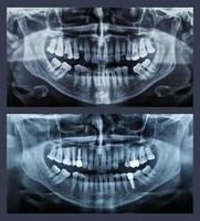 ortopantomógrafo imagem panorâmica radiografia de dentes foto