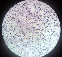 anemia por deficiência de ferro foto