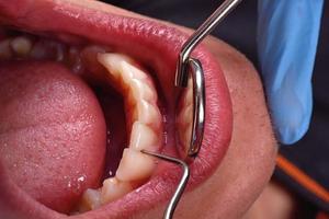 boca aberta do paciente foto