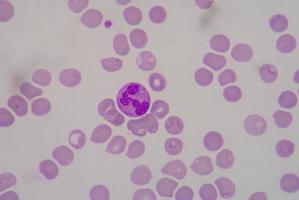 glóbulos vermelhos formam microcitose. foto