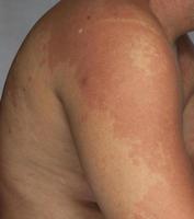 pele humana, apresentando reação alérgica, erupção cutânea alérgica. foto