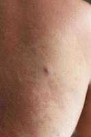 pele humana, apresentando reação alérgica, erupção cutânea alérgica. foto
