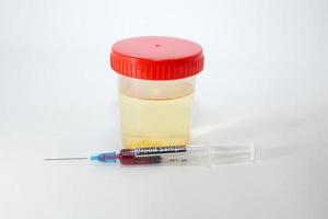 amostra com urina para exame de urina e uma seringa com sangue foto